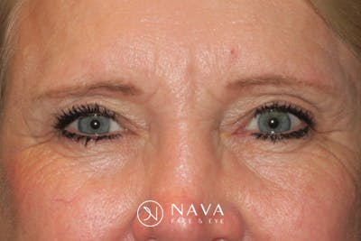 Upper Blepharoplasty (Upper Eyelid Surgery) Before & After Gallery - Patient 148992215 - Image 2