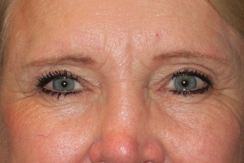 Upper Blepharoplasty (Upper Eyelid Surgery) Before & After Gallery - Patient 148992215 - Image 2