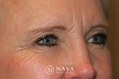 Upper Blepharoplasty (Upper Eyelid Surgery) Before & After Gallery - Patient 148992215 - Image 4