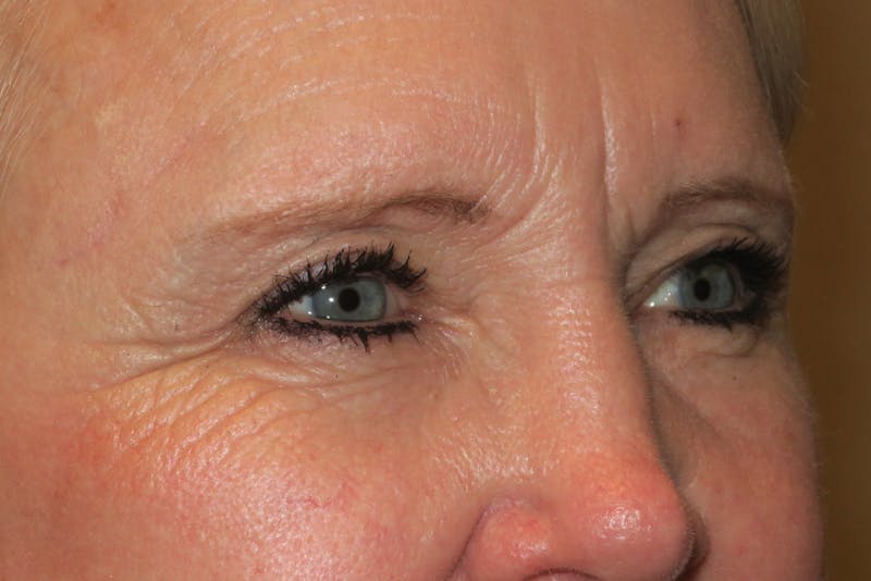 Browplasty (Brow Lift) Before & After Gallery - Patient 148992213 - Image 4