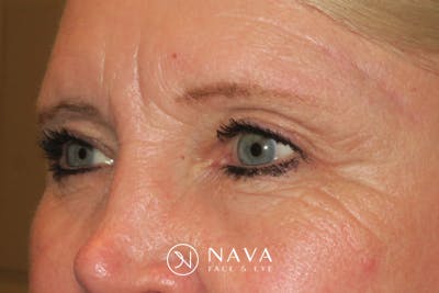 Upper Blepharoplasty (Upper Eyelid Surgery) Before & After Gallery - Patient 148992215 - Image 6