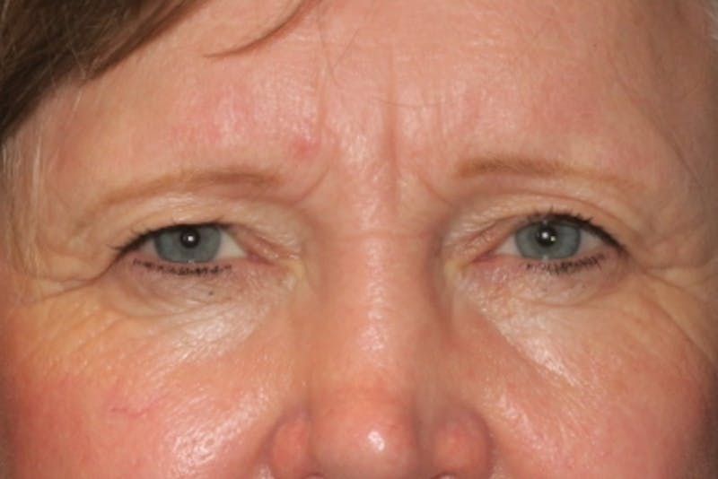 Upper Blepharoplasty (Upper Eyelid Surgery) Before & After Gallery - Patient 148992215 - Image 1