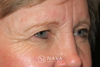 Upper Blepharoplasty (Upper Eyelid Surgery) Before & After Gallery - Patient 148992215 - Image 3