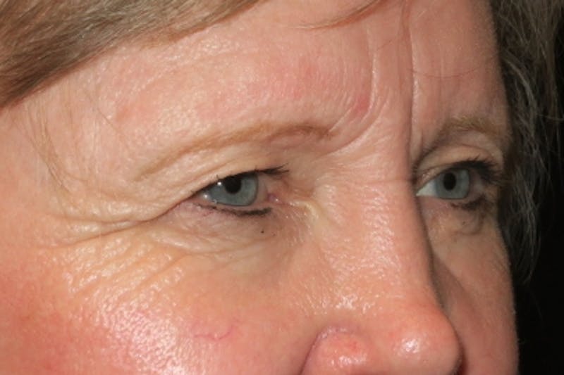 Upper Blepharoplasty (Upper Eyelid Surgery) Before & After Gallery - Patient 148992215 - Image 3