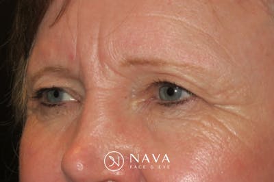 Upper Blepharoplasty (Upper Eyelid Surgery) Before & After Gallery - Patient 148992215 - Image 5