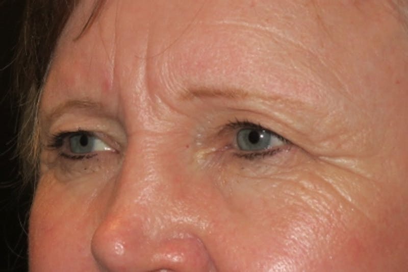 Browplasty (Brow Lift) Before & After Gallery - Patient 148992213 - Image 5