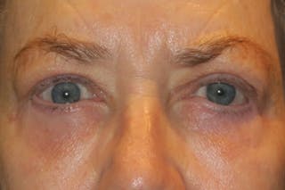 Ptosis Repair Before & After Gallery - Patient 148992222 - Image 2
