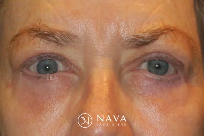 Upper Blepharoplasty (Upper Eyelid Surgery) Before & After Gallery - Patient 148992223 - Image 2