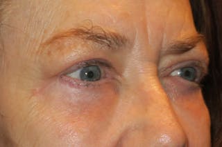Ptosis Repair Before & After Gallery - Patient 148992222 - Image 4