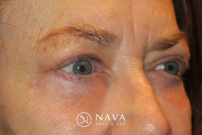 Upper Blepharoplasty (Upper Eyelid Surgery) Before & After Gallery - Patient 148992223 - Image 4