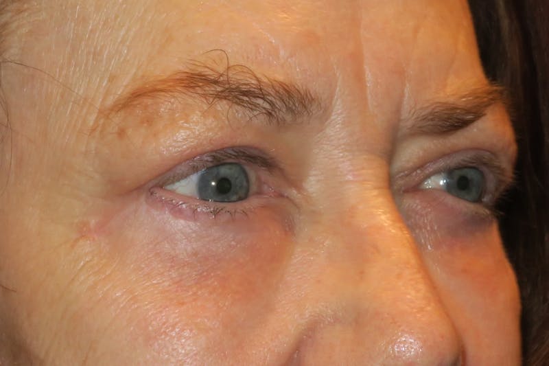 Upper Blepharoplasty (Upper Eyelid Surgery) Before & After Gallery - Patient 148992223 - Image 2