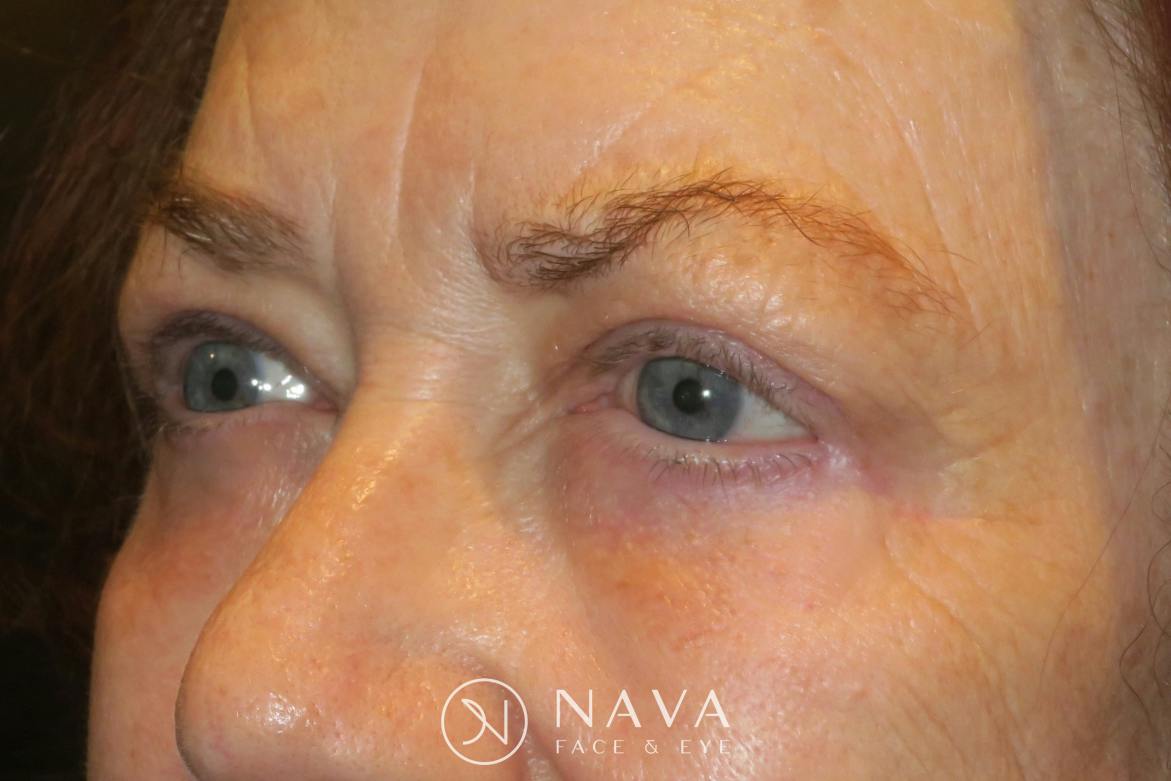 Bleph Light Lower Blepharoplasty (Lower Eyelid Surgery) Before & After Photos ...