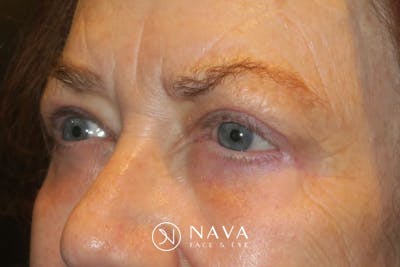 Upper Blepharoplasty (Upper Eyelid Surgery) Before & After Gallery - Patient 148992223 - Image 6