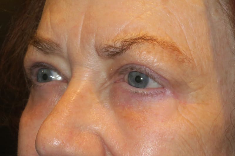 Ptosis Repair Before & After Gallery - Patient 148992222 - Image 3