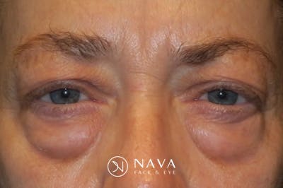 Upper Blepharoplasty (Upper Eyelid Surgery) Before & After Gallery - Patient 148992223 - Image 1