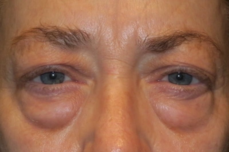 Upper Blepharoplasty (Upper Eyelid Surgery) Before & After Gallery - Patient 148992223 - Image 1