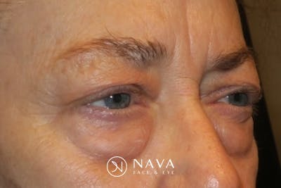 Upper Blepharoplasty (Upper Eyelid Surgery) Before & After Gallery - Patient 148992223 - Image 3