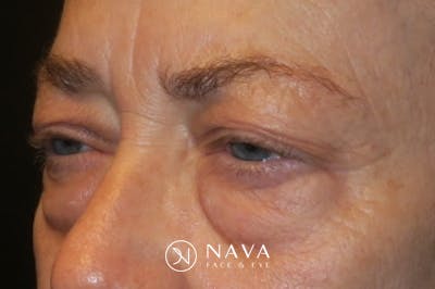 Upper Blepharoplasty (Upper Eyelid Surgery) Before & After Gallery - Patient 148992223 - Image 5