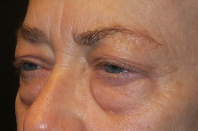 Lower Blepharoplasty (Lower Eyelid Surgery) Before & After Gallery - Patient 148992221 - Image 5