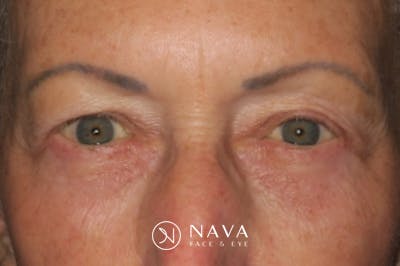 Upper Blepharoplasty (Upper Eyelid Surgery) Before & After Gallery - Patient 148992227 - Image 2