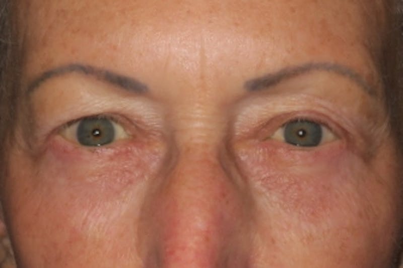 Lower Blepharoplasty (Lower Eyelid Surgery) Before & After Gallery - Patient 148992225 - Image 2