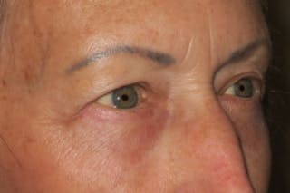Lower Blepharoplasty (Lower Eyelid Surgery) Before & After Gallery - Patient 148992225 - Image 4