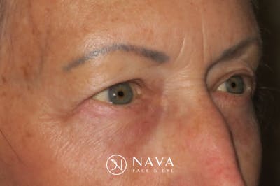 Upper Blepharoplasty (Upper Eyelid Surgery) Before & After Gallery - Patient 148992227 - Image 4