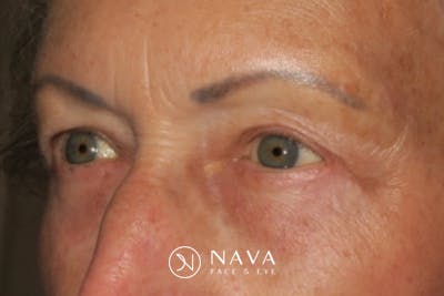 Upper Blepharoplasty (Upper Eyelid Surgery) Before & After Gallery - Patient 148992227 - Image 6