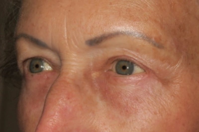 Ptosis Repair Before & After Gallery - Patient 148992226 - Image 6