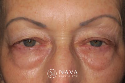 Upper Blepharoplasty (Upper Eyelid Surgery) Before & After Gallery - Patient 148992227 - Image 1