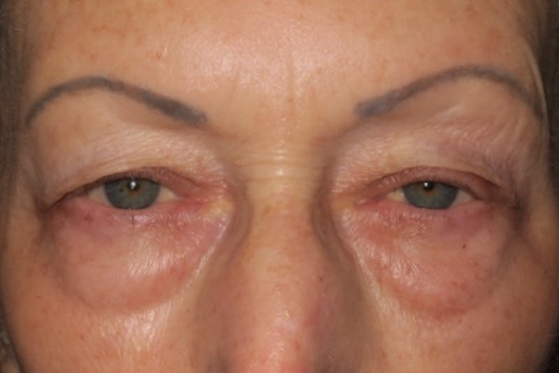 Lower Blepharoplasty (Lower Eyelid Surgery) Before & After Gallery - Patient 148992225 - Image 1