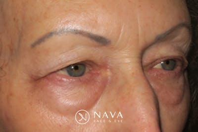 Upper Blepharoplasty (Upper Eyelid Surgery) Before & After Gallery - Patient 148992227 - Image 3