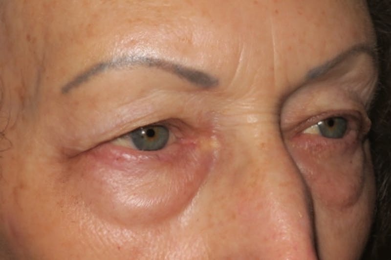 Lower Blepharoplasty (Lower Eyelid Surgery) Before & After Gallery - Patient 148992225 - Image 3