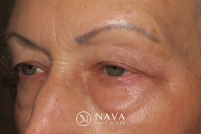 Upper Blepharoplasty (Upper Eyelid Surgery) Before & After Gallery - Patient 148992227 - Image 5