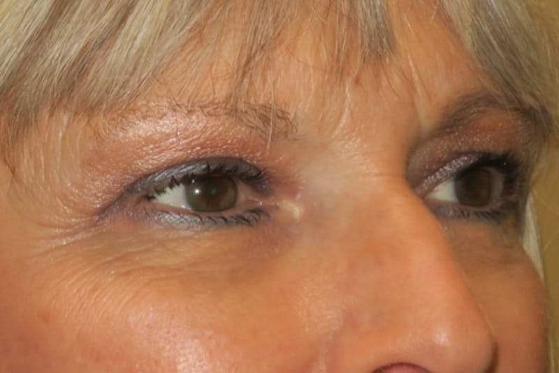 Browplasty (Brow Lift) Before & After Gallery - Patient 148992247 - Image 4