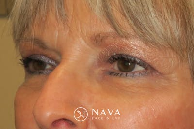 Upper Blepharoplasty (Upper Eyelid Surgery) Before & After Gallery - Patient 148992246 - Image 6