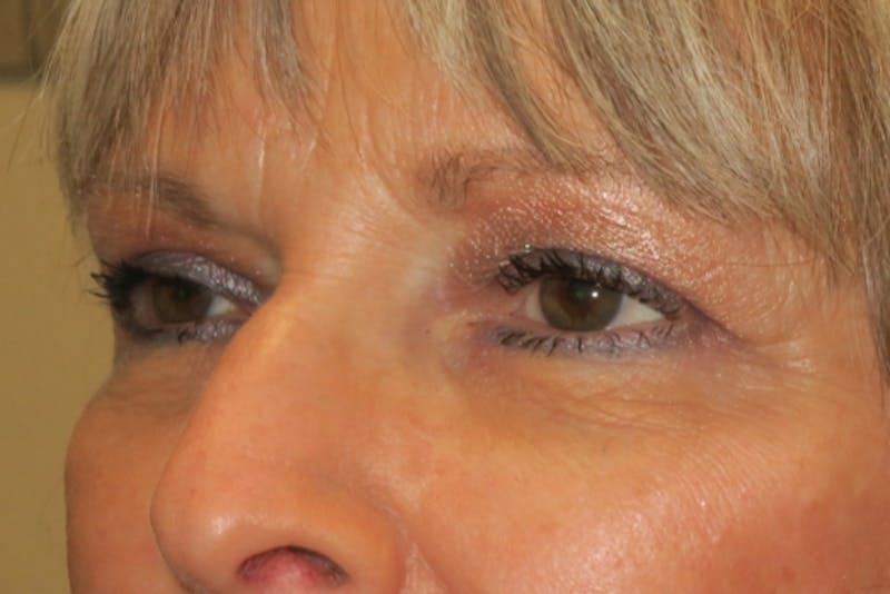 Upper Blepharoplasty (Upper Eyelid Surgery) Before & After Gallery - Patient 148992246 - Image 6