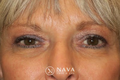 Upper Blepharoplasty (Upper Eyelid Surgery) Before & After Gallery - Patient 148992246 - Image 2