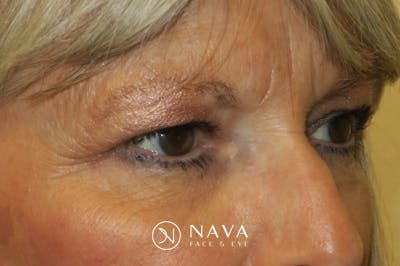 Upper Blepharoplasty (Upper Eyelid Surgery) Before & After Gallery - Patient 148992246 - Image 3