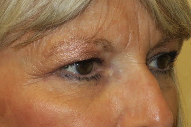 Upper Blepharoplasty (Upper Eyelid Surgery) Before & After Gallery - Patient 148992246 - Image 3