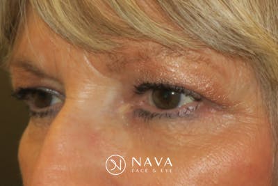 Upper Blepharoplasty (Upper Eyelid Surgery) Before & After Gallery - Patient 148992246 - Image 5