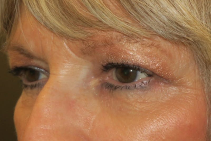 Upper Blepharoplasty (Upper Eyelid Surgery) Before & After Gallery - Patient 148992246 - Image 5