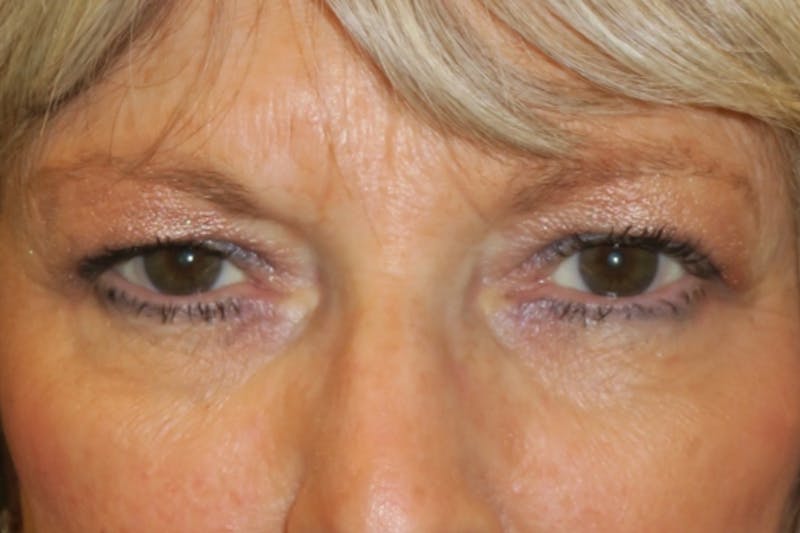 Browplasty (Brow Lift) Before & After Gallery - Patient 148992247 - Image 1