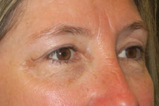 Upper Blepharoplasty (Upper Eyelid Surgery) Before & After Gallery - Patient 148992249 - Image 4