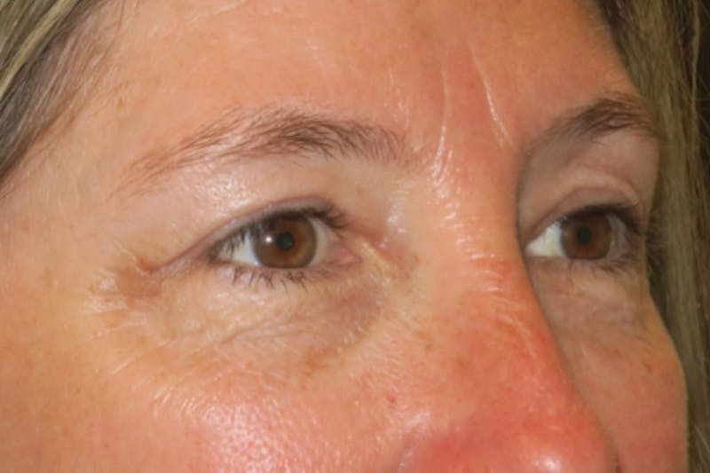 Upper Blepharoplasty (Upper Eyelid Surgery) Before & After Gallery - Patient 148992249 - Image 4