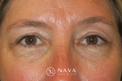 Upper Blepharoplasty (Upper Eyelid Surgery) Before & After Gallery - Patient 148992249 - Image 2