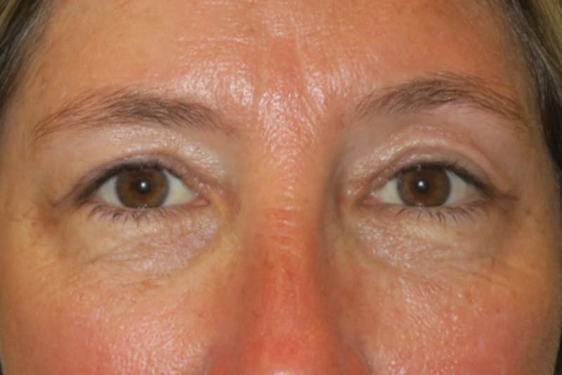 Upper Blepharoplasty (Upper Eyelid Surgery) Before & After Gallery - Patient 148992249 - Image 2