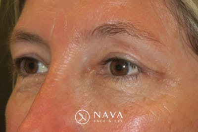 Upper Blepharoplasty (Upper Eyelid Surgery) Before & After Gallery - Patient 148992249 - Image 6
