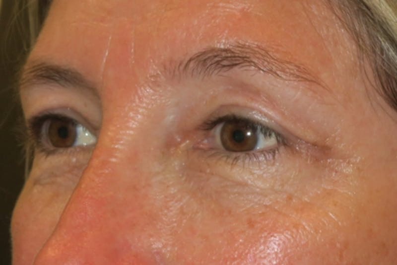 Upper Blepharoplasty (Upper Eyelid Surgery) Before & After Gallery - Patient 148992249 - Image 6
