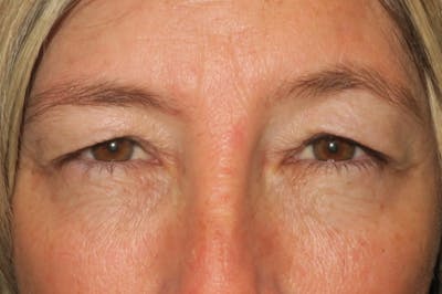 Upper Blepharoplasty (Upper Eyelid Surgery) Before & After Gallery - Patient 148992249 - Image 1